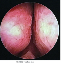 Imagem Hiperplasia Prostática Benigna