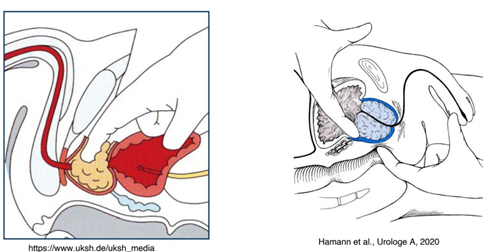 Cirurgia aberta para Hiperplasia Prostática Benigna