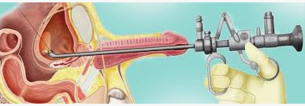 tecnica convencional para tratar Hiperplasia Prostática Benigna