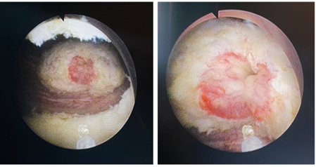 enucleação prostática a laser
