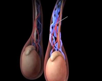 varicocele