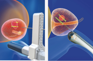 target biopsy