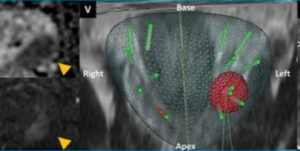 target biopsy