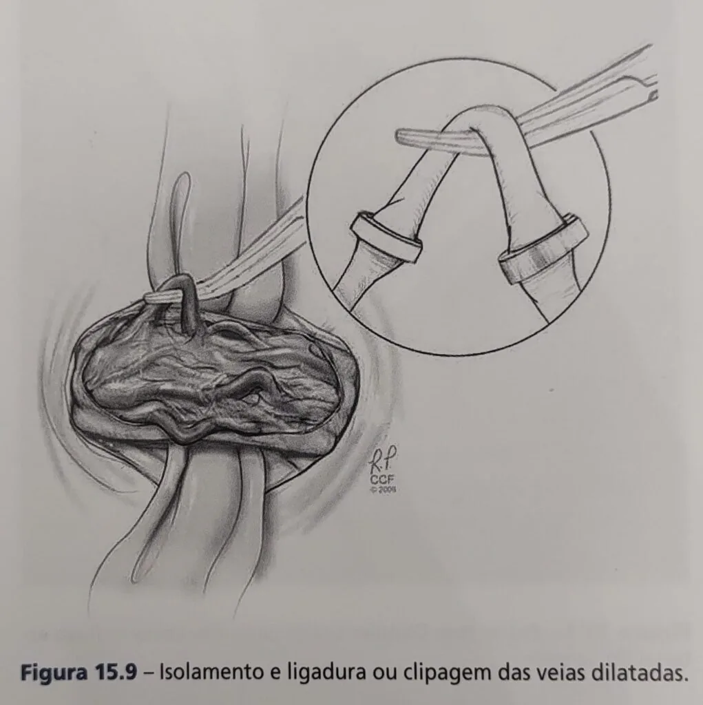 Desenho Varicocele