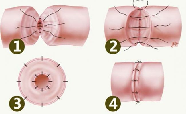 Reversão de Vasectomia Microcirúrgica