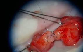 Reversão de Vasectomia Microcirúrgica