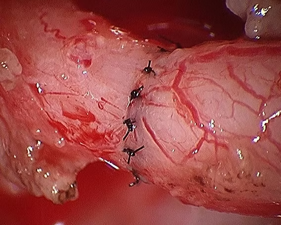 Reversão de Vasectomia Microcirúrgica
