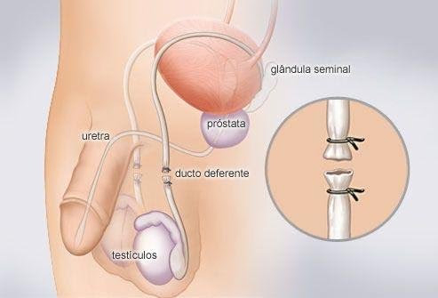 Reversão de Vasectomia