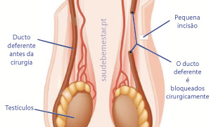 Reversão de Vasectomia