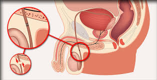vasovasostomia - Reversão de Vasectomia