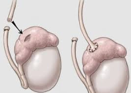 vasoepididostomia - Reversão de Vasectomia