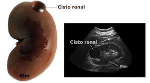 Cisto de Rim