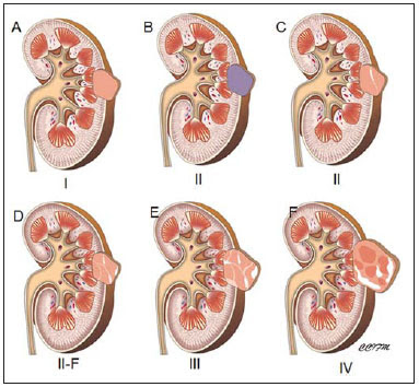 Classificação Cisto Renal