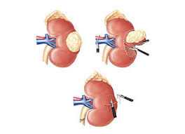 Cirurgia Robótica no Câncer de Rim