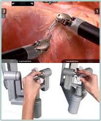 Cirurgia Robótica no Câncer de Rim