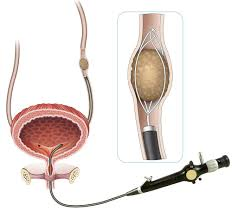 ureteroflexivel