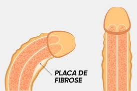 Placa fibrosa doença de peyronie