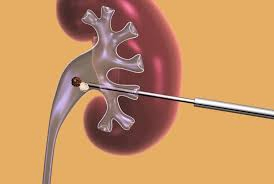 Nefrolitotripsia Percutânea