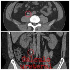 ureterolitíase