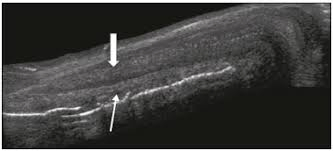 ultrassom doença de peyronie