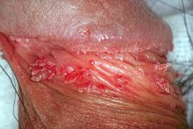 HPV EM PÊNIS