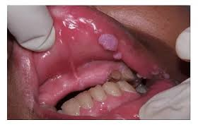 HPV EM BOCA