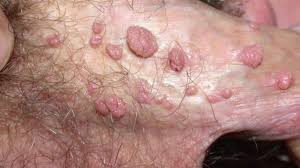 HPV EM PÊNIS
