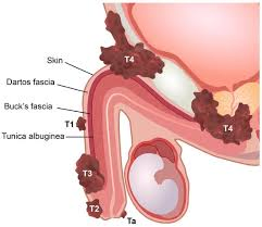 HPV EM PÊNIS