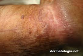 HPV EM PÊNIS