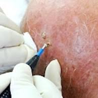 HPV EM PÊNIS