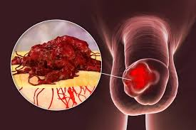 HPV EM PÊNIS