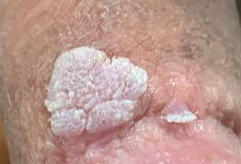 HPV EM PÊNIS