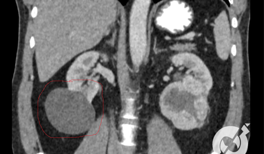 cisto renal