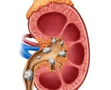 NEFROLITÍASE