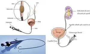 Ureterorrenolitotripsia com Laser
