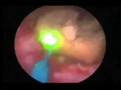 LASER