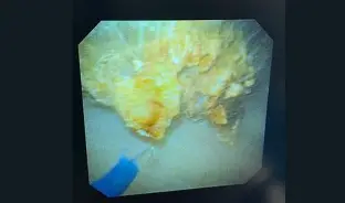 LASER