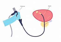 cistoscópio flexível