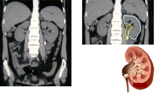 ureterolitíase