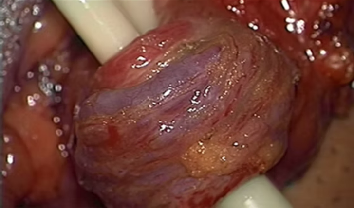 Microcirurgia