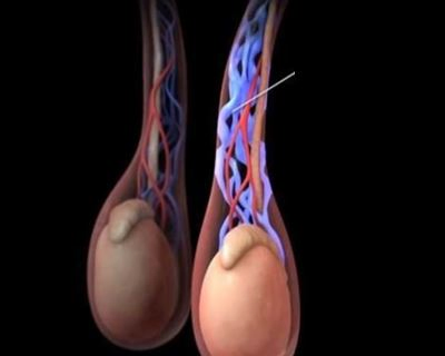 varicocele