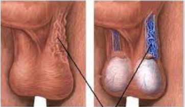 varicocele