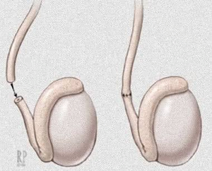 Reversão de vasectomia Microcirúrgica