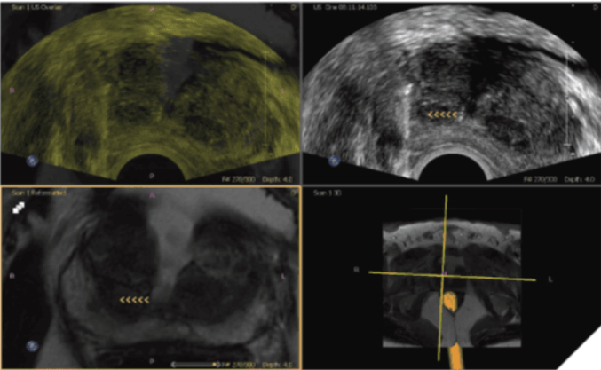 biópsia transperineal por fusão