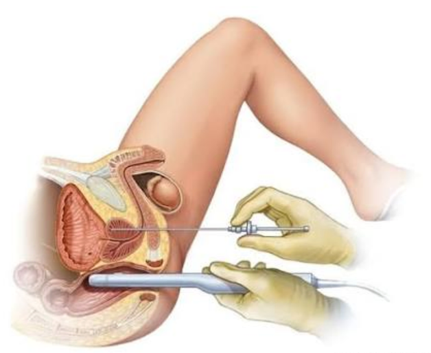 biópsia transperineal